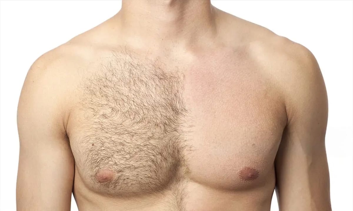 Épilation laser homme torse à Paris au Soprano Titanium · VivaSkin Esthétique Paris 16