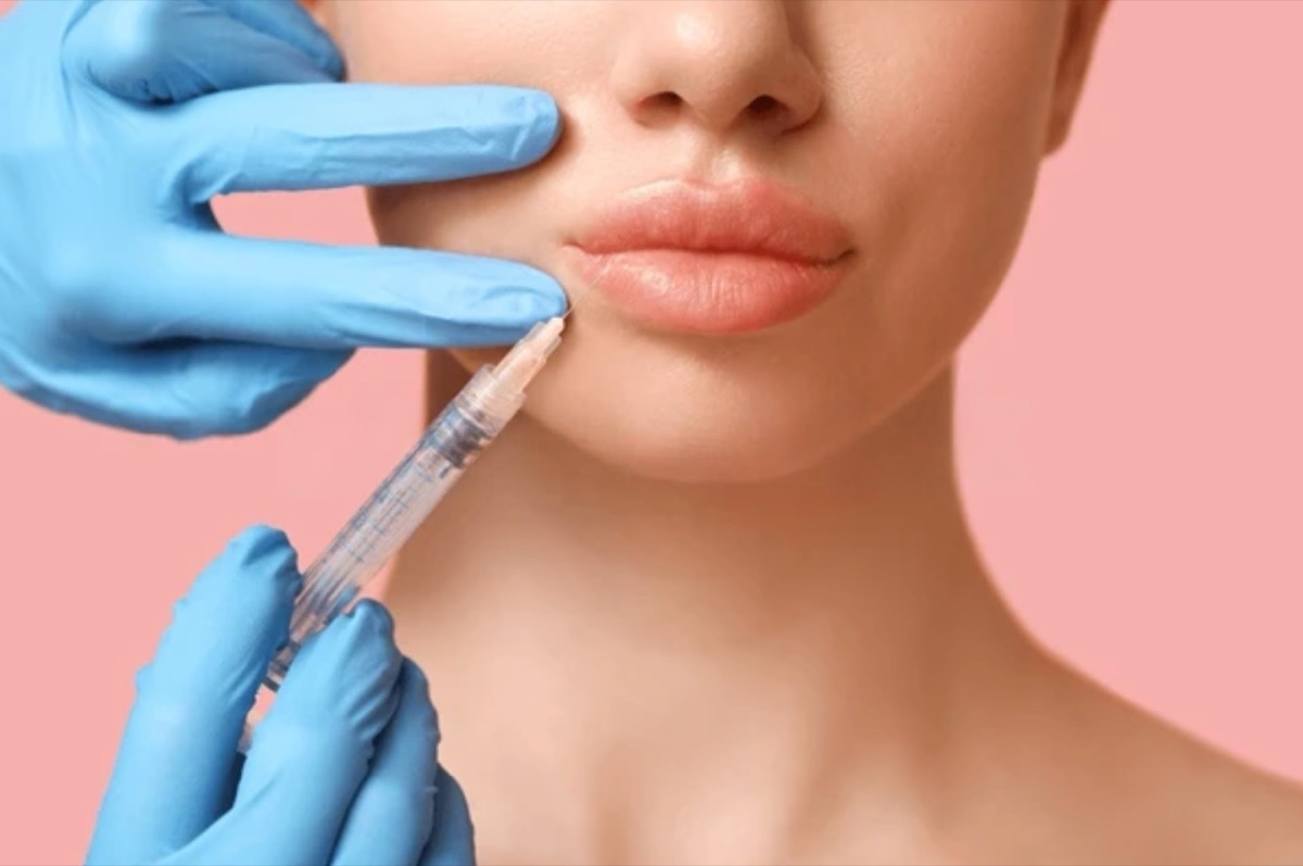 Injection d acide hyaluronique dans les lèvres réalisée par un médecin à Paris