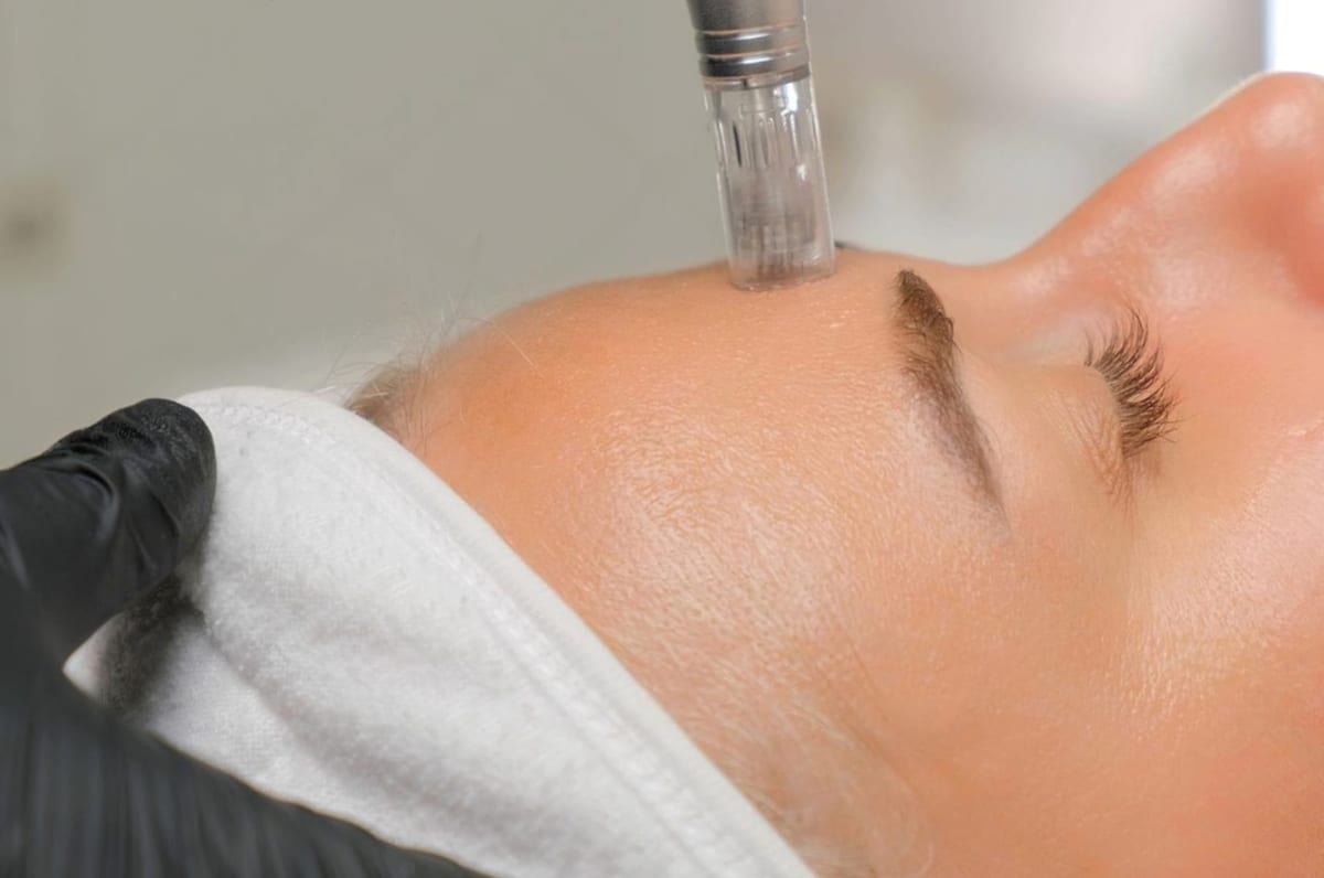 Microneedling Paris 16 Genosys Alma VivaSkin Esthétique