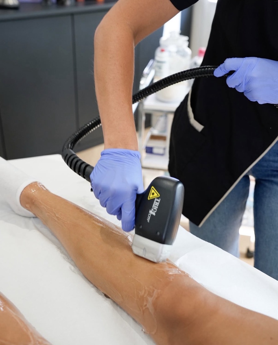 Flora, praticienne diplômée VivaSkin Esthétique, applique la pièce à main TRIO Clarity du laser Soprano Titanium d'Alma Lasers sur une jambe enduite de gel de contact en cabine Paris 16